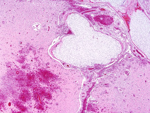 5B5 Infarcts, embolic, chondrosarcoma (Case 5) H&E WM 6