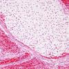 5B6 Infarcts, embolic, chondrosarcoma (Case 5) H&E 7