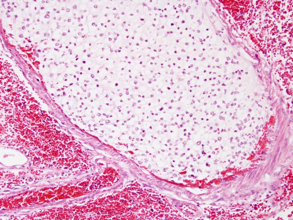 5B6 Infarcts, embolic, chondrosarcoma (Case 5) H&E 7