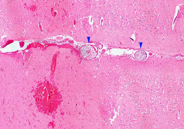 5B7 Infarcts, embolic, ChondroSA (Case 5) D H&E  WM copy