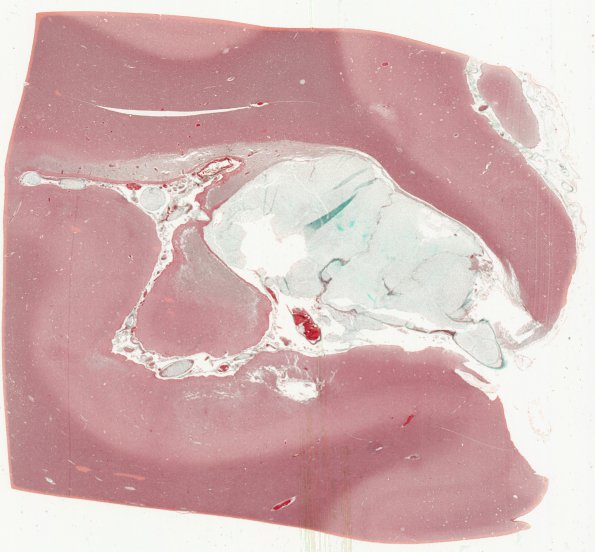 5C1 Infarcts, embolic, chondrosarcoma (Case 5) Trichrome WM