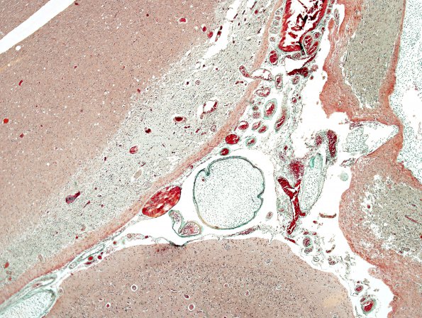 5C2 Infarcts, embolic, chondrosarcoma (Case 5) Trichrome 3