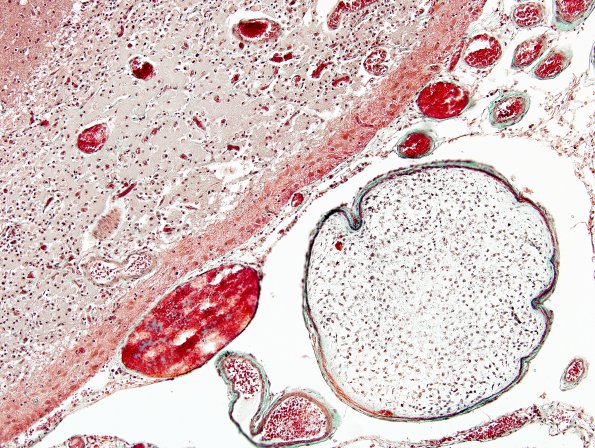 5C3 Infarcts, embolic, chondrosarcoma (Case 5) Trichrome 2