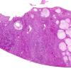 5D1 Infarcts, embolic, ChondroSA (Case 5) L2 Kidney  H&E WM