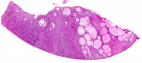 5D1 Infarcts, embolic, ChondroSA (Case 5) L2 Kidney  H&E WM