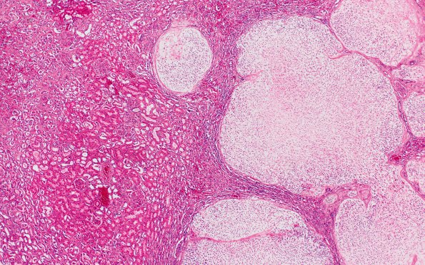 5D2 Infarcts, embolic, ChondroSA (Case 5) L2 Kidney  H&E 4X