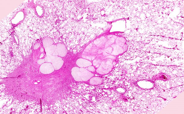 5D3 Infarcts, embolic, ChondroSA (Case 5) L2 Kidney  H&E 4X lung 2