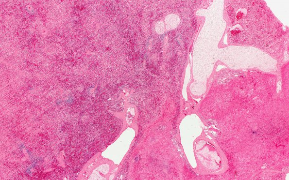 5D4 Infarcts, embolic, ChondroSA (Case 5) Spleen 2X