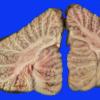 6B6 Infarcts, embolic (Hypoplastic Hrt x surgeries, Case 6) Gross_26