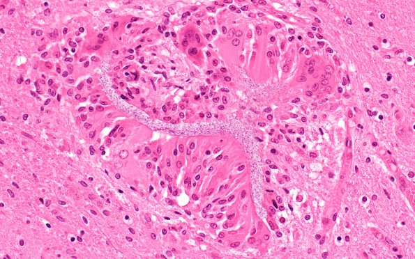 6B8 Infarcts, embolic (Hypoplastic Hrt x surgeries, Case 6) N20 40X