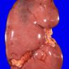 6C1 Infarcts, embolic (Hypoplastic Hrt x surgeries, Case 6) Gross_1