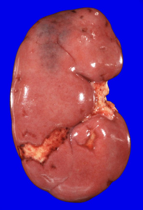 6C1 Infarcts, embolic (Hypoplastic Hrt x surgeries, Case 6) Gross_1