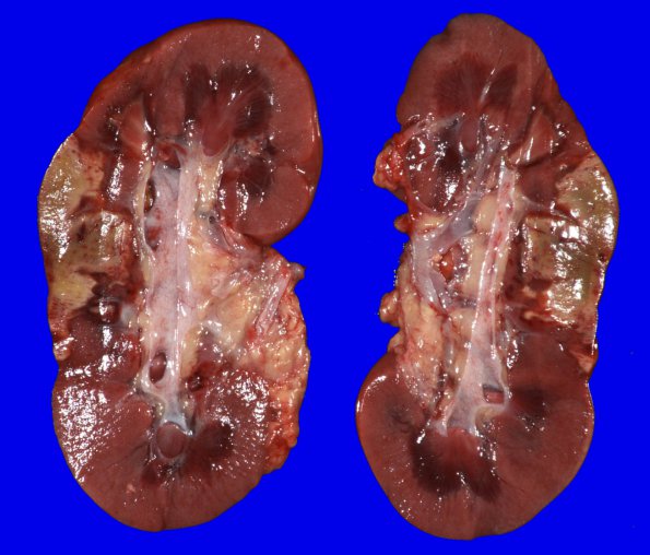 6C2  Infarcts, embolic (Hypoplastic Hrt x surgeries, Case 6) Gross_5