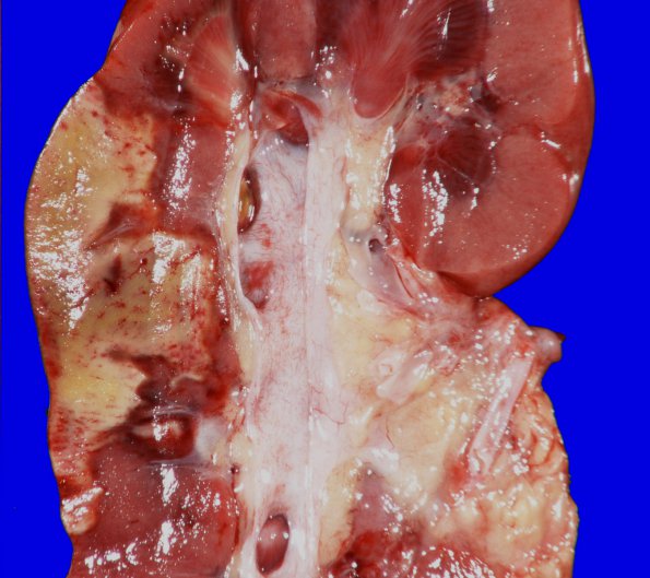 6C3 Infarcts, embolic (Hypoplastic Hrt x surgeries, Case 6) Gross_6