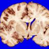 7A1 Infarct, hemorrhagic (Case 7) 4A