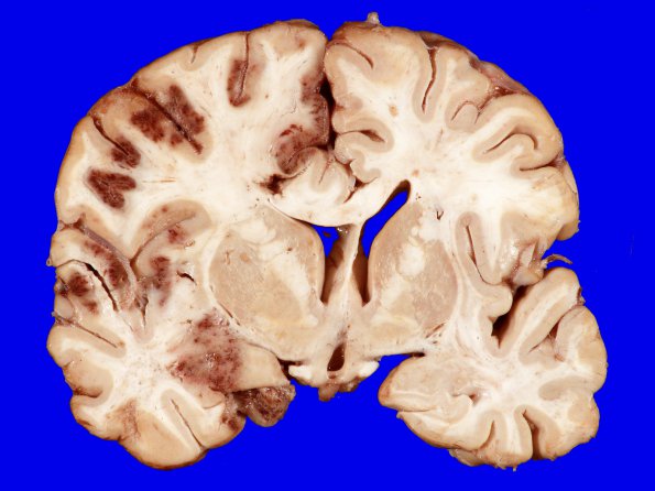 7A1 Infarct, hemorrhagic (Case 7) 4A