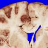 7A2 Infarct, hemorrhagic (Case 7) 5A