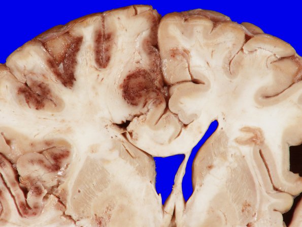 7A2 Infarct, hemorrhagic (Case 7) 5A