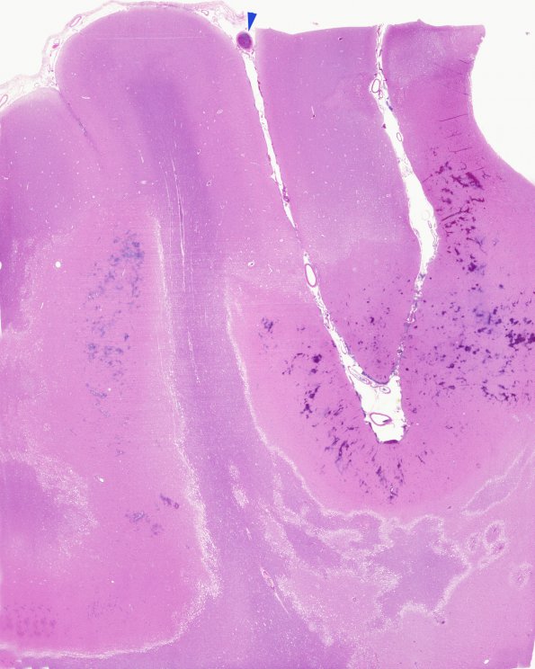 7B1 Infarct, embolic (Case 7) H&E 1A copy