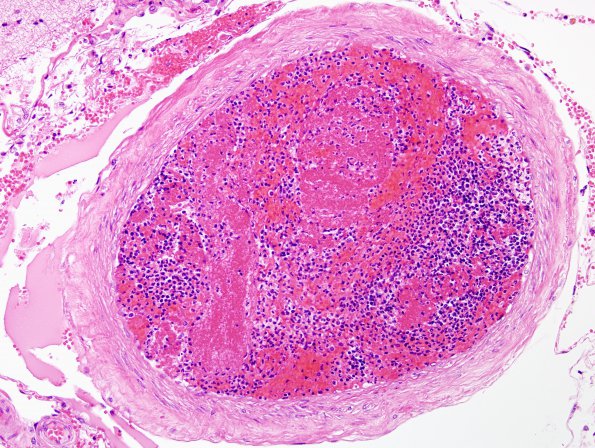 7B2 Infarct, embolic (Case 7) H&E 1B