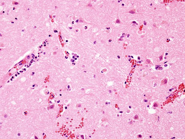 7B3 Infarct, hemorrhagic, recent (Case 7) H&E 3