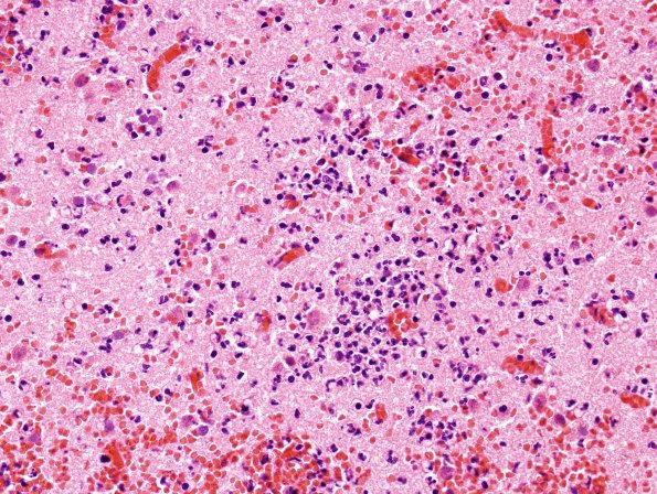 7B4 Infarct, hemorrhagic, recent (Case 7) H&E 2