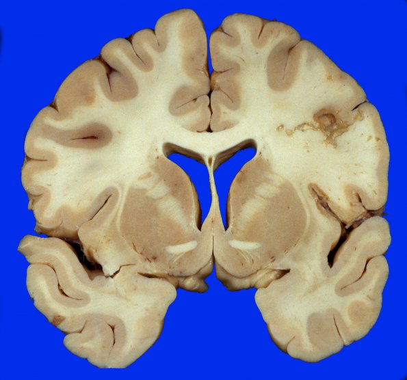 8A1 Infarcts, embolic, SLE L-S (Case 8) 5