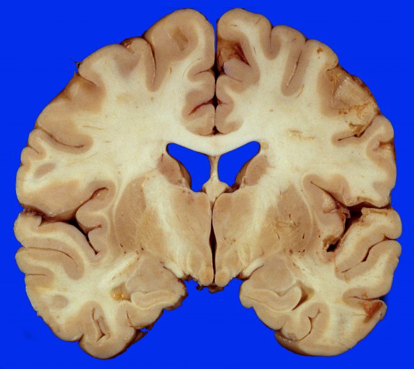 8A2 Infarcts, embolic, SLE L-S (Case 8) 3