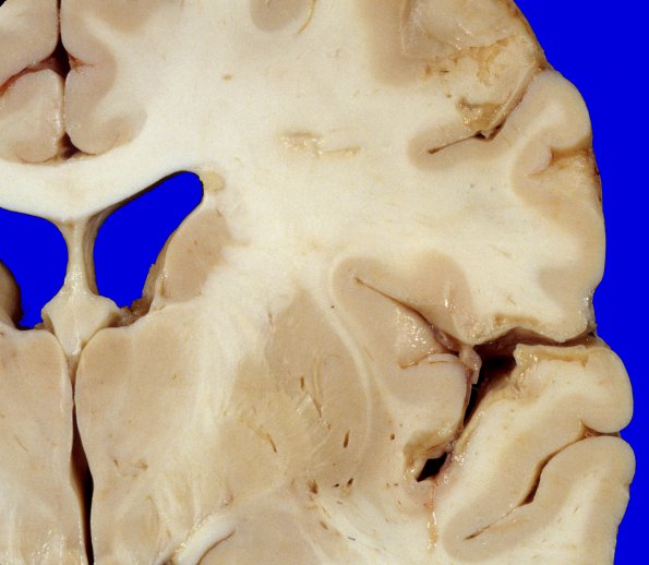 8A3 Infarcts, embolic, SLE L-S (Case 8) 2