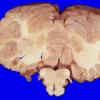 8A4 Infarcts, embolic, SLE L-S (Case 8) 4 copy