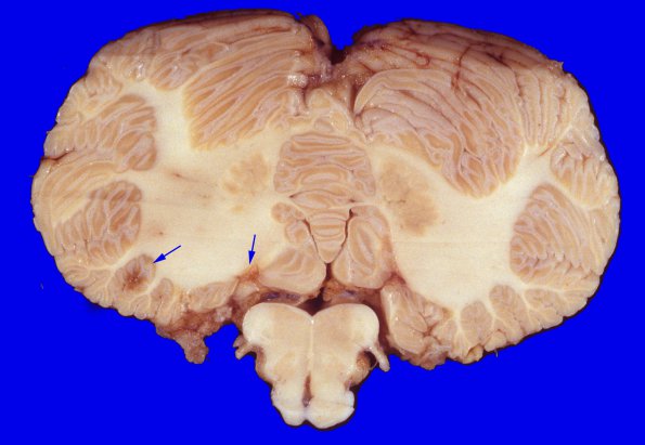 8A4 Infarcts, embolic, SLE L-S (Case 8) 4 copy