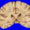 9A1 Infarct, Embolic (Hrt fibrin plt emboli) Case 9 gross 2