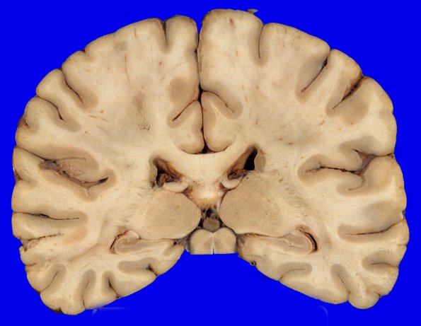 9A1 Infarct, Embolic (Hrt fibrin plt emboli) Case 9 gross 2