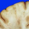 9A2 Infarct, Embolic (Hrt fibrin plt emboli) Case 9 gross 9