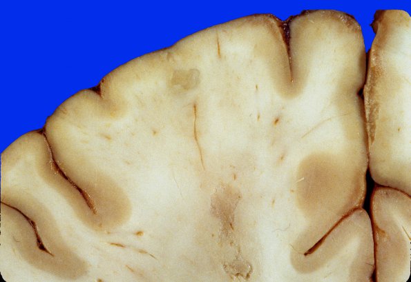 9A2 Infarct, Embolic (Hrt fibrin plt emboli) Case 9 gross 9