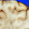 9A3 Infarct, Embolic (Hrt fibrin plt emboli) Case 9 6