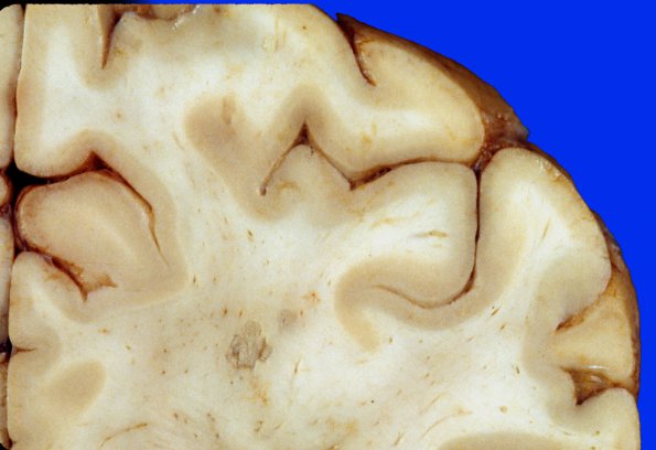 9A3 Infarct, Embolic (Hrt fibrin plt emboli) Case 9 6