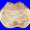 9A4 Infarct, Embolic thrombi) (Case 9) 2