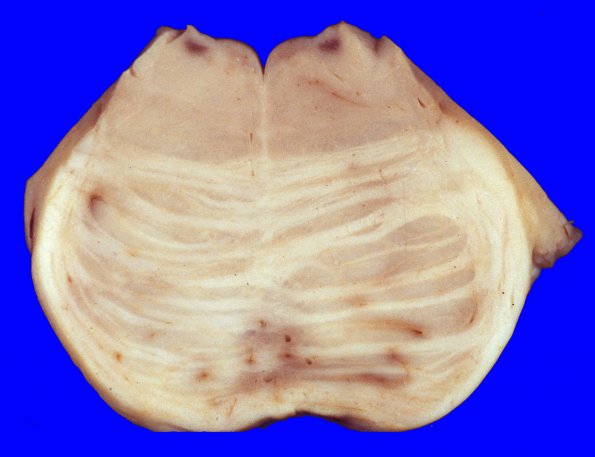 9A4 Infarct, Embolic thrombi) (Case 9) 2