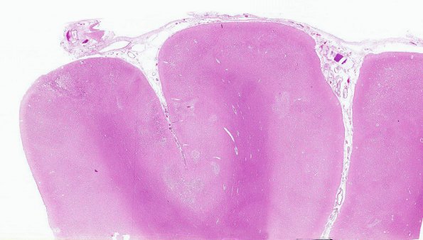 9B1 Infarct, Embolic (Hrt fibrin plt emboli) Case 9 Older Lesion 7