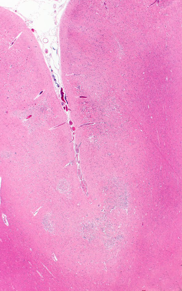 9B2 Infarct, Embolic thrombi) (Case 9) 2XX