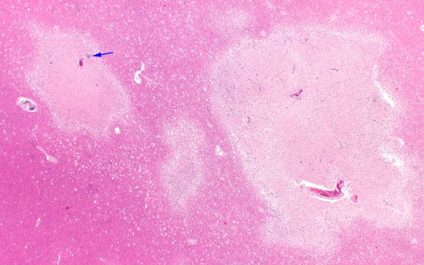 9B3A Infarct, Embolic thrombi) (Case 9) 2X 2 copy