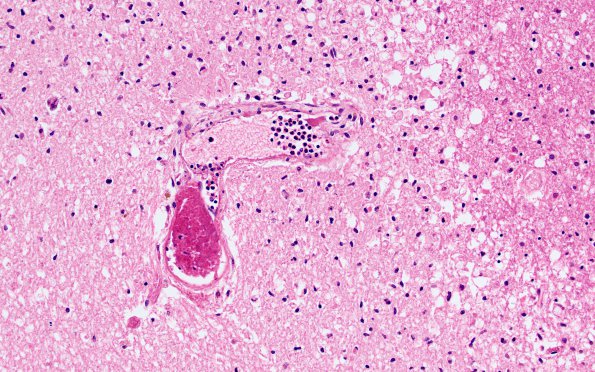 9B3B Infarct, Embolic thrombi) (Case 9) 20X 2