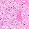 9B4B Infarct, Embolic thrombi) (Case 9) 20X