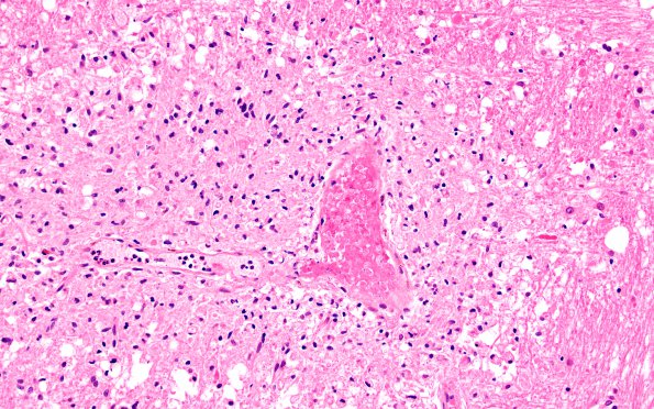 9B4B Infarct, Embolic thrombi) (Case 9) 20X