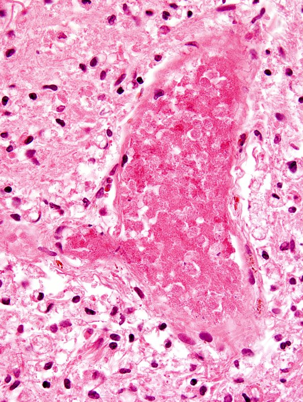 9B4C Infarct, Embolic (Hrt fibrin plt emboli) Case 9 i