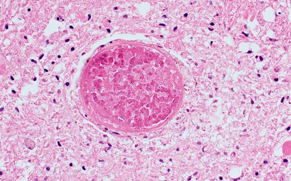 9B4D Infarct, Embolic thrombi) (Case 9) 40X 2