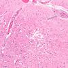 9B5A Infarct, Embolic thrombi) (Case 9) 10X