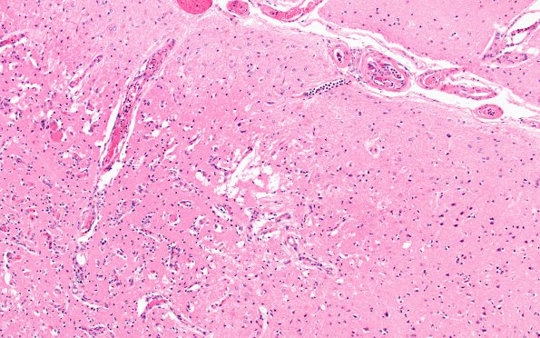 9B5A Infarct, Embolic thrombi) (Case 9) 10X