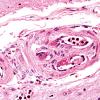 9B5B Infarct, Embolic (Hrt fibrin plt emboli) Case 9 Older Lesion 2